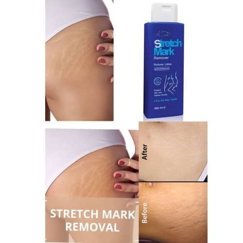 Stretch Mark Remover - 400ml