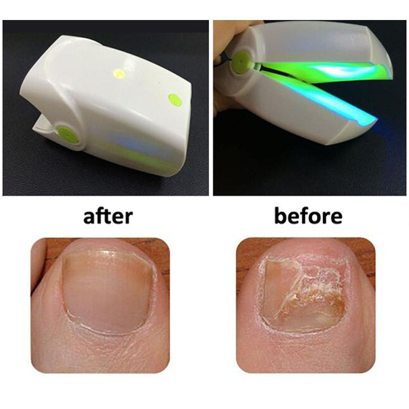 ToeNail Fungus Care Low Laser Therapy Device Onychomycosis