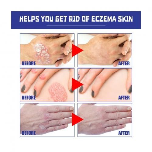 Psoriasis Relief Spray X2