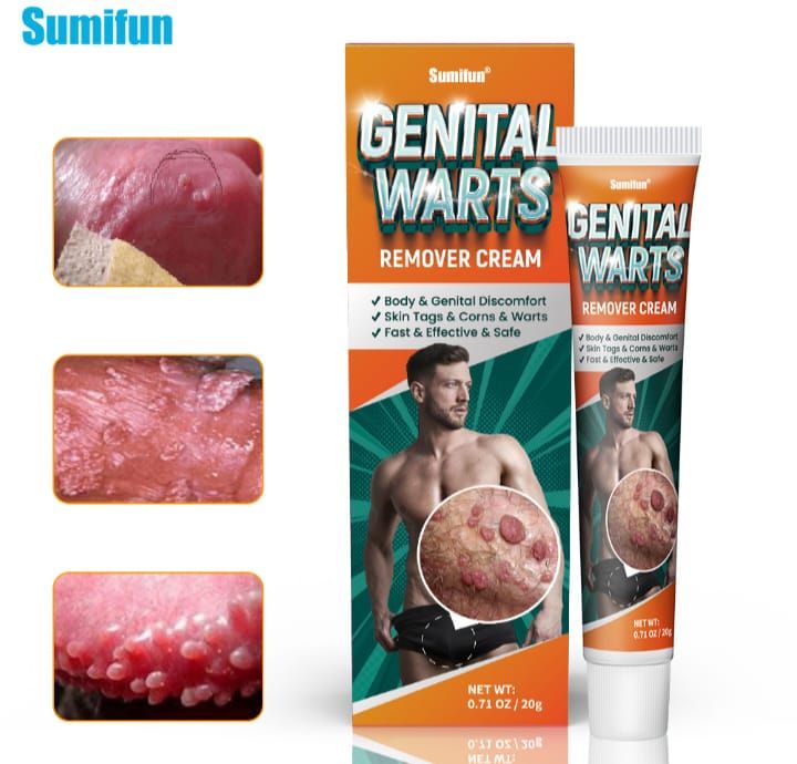 Powerful Genital Wart Removal Cream