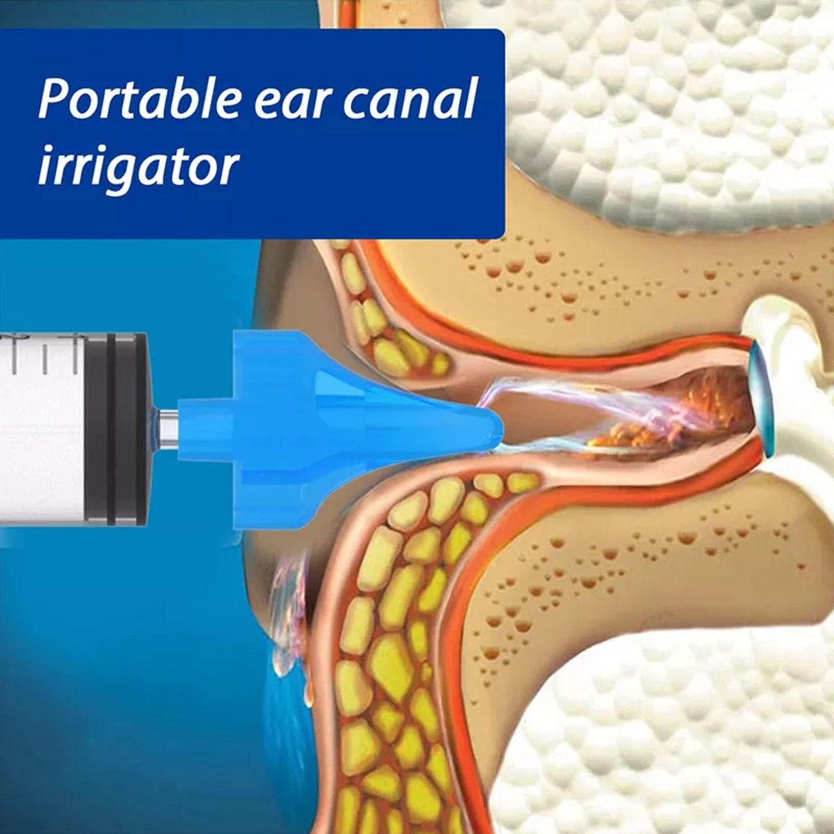 2Pcs Ear Canal Irrigator Earwax Remover Soft Ear Tips Ear Wax Flusher Irrigation Syringe Adult WJ