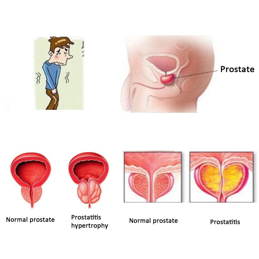 Prostatic Health Urology Navel Man Prostatitis Prostate Patch Patches Urological Medical ZB Plaster Pcs Care Treatment 20