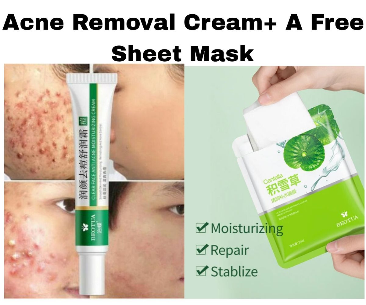 Acne Removal Cream  ( Acne Spots & Oil Control Acne Cream ) + A Free Sheet Mask