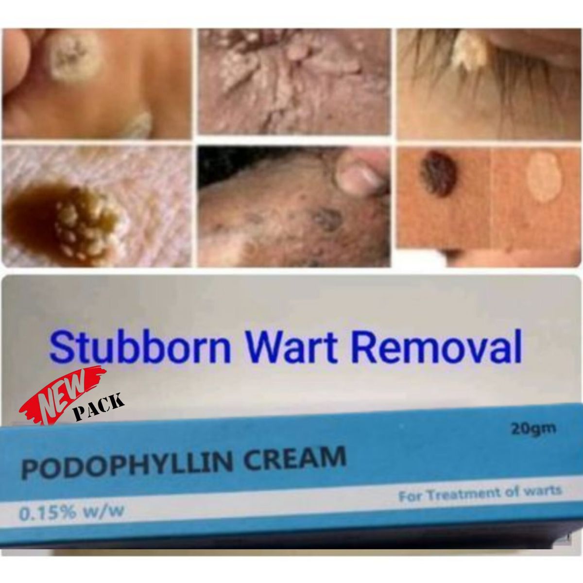 Podowart Podophyllin Cream For Wart Treatment