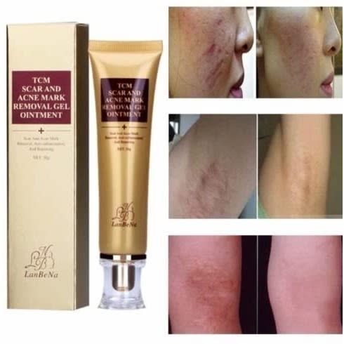 Lanbena Tcm Scar And Acne Mark Removal Gel Ointment Acne Scar Cream 30g