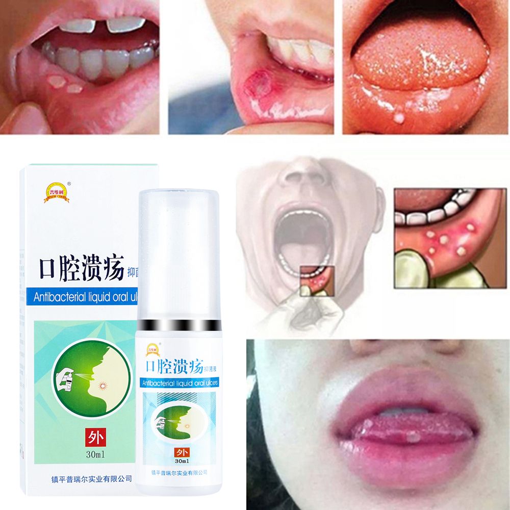 30ml Natural Herbal Mouth Ulcer Pain Relief Spray Anti Care