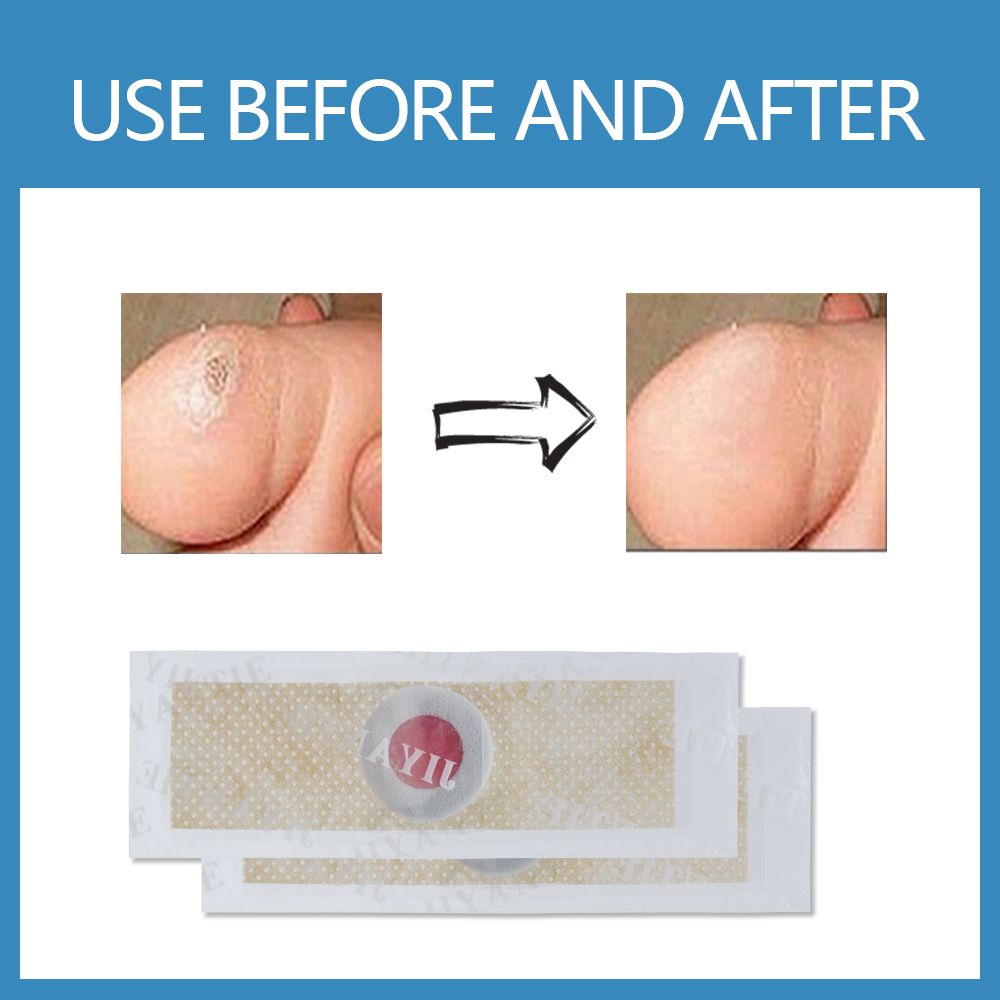 Feet Patch Corn Callus Tool Medical Warts Thorn Care Foot Painless Feet Hot Soften Care Removal 40Pcs Remover C584 Plaster Skin