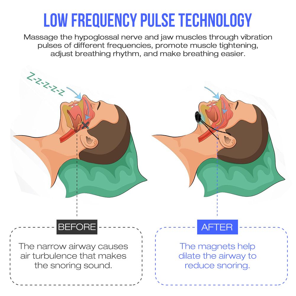 Smart Anti Snoring Device Portable  Nasal Noise Reduct Low-frequency Pulse Comfortable Sleep Well Snore Stopper Health Care