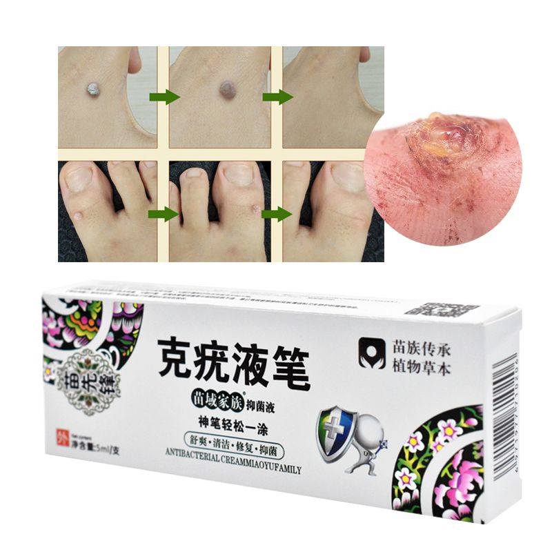 Papillomas Removing Removal Remedy Warts Moles Tags Treatment Skin Verruca 1pc Liquid Anti Of Wart Genital Against Remover From