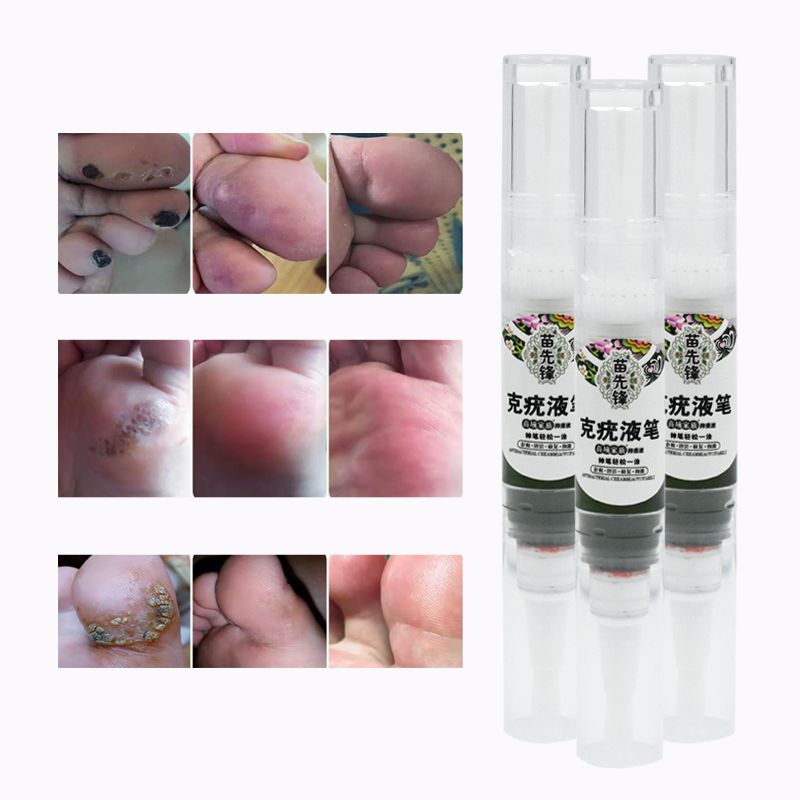 Papillomas Removing Removal Remedy Warts Moles Tags Treatment Skin Verruca 1pc Liquid Anti Of Wart Genital Against Remover From