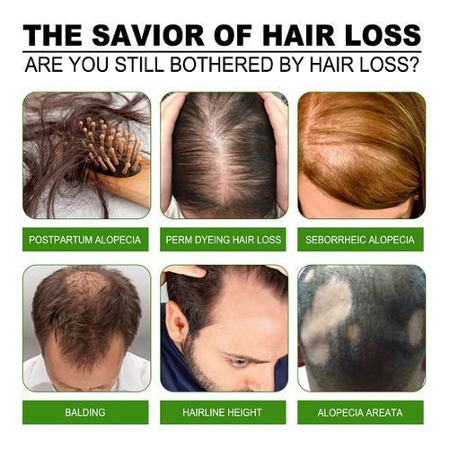 Hair Maximum Fast Hair Growth ,Anti Hair Loss  Serum