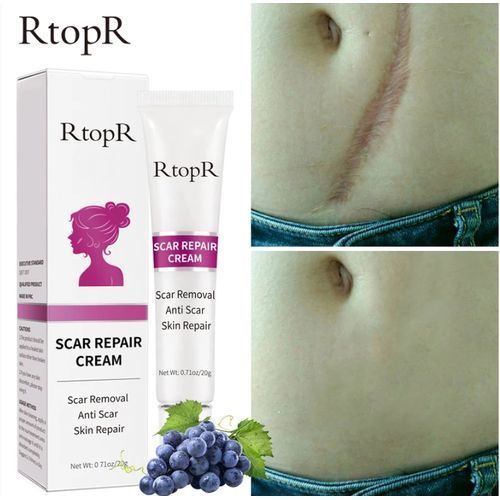 Keloids Scar Cream - Acne Scar Stretch Marks Remover Keloids Cream Skin Repair Face Cream Acne Spots Acne Treatment Blackhead Whitening Cream Skin Care