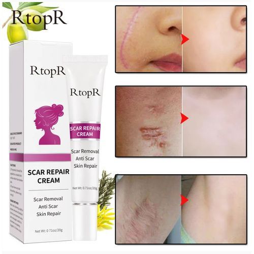 Keloids Scar Cream - Acne Scar Stretch Marks Remover Keloids Cream Skin Repair Face Cream Acne Spots Acne Treatment Blackhead Whitening Cream Skin Care