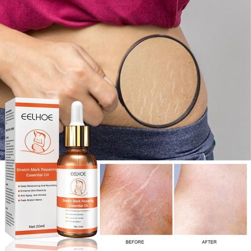 - Effective Stretch Mark Instant Removal Oil .