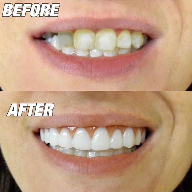 5pcs  Beauty Tool False Teeth Fake Tooth Cover