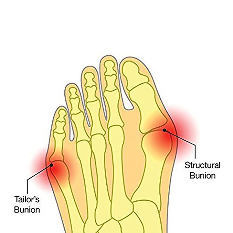 1pair Big Toe Hallux Valgus Corrector Orthotics Feet Care