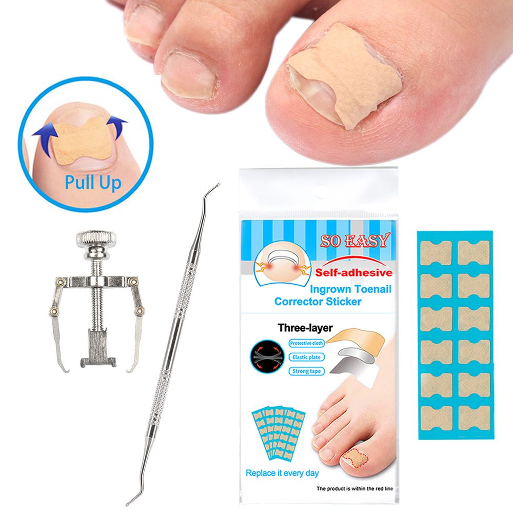 Ingrown Nail Correction Kit Ingrown Toenail Stickers Toe