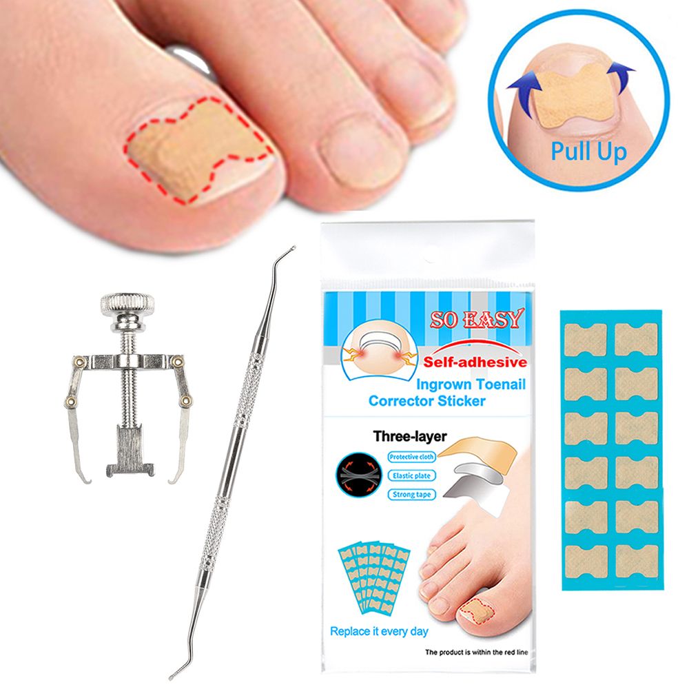 Ingrown Nail Correction Kit Ingrown Toenail Stickers Toe