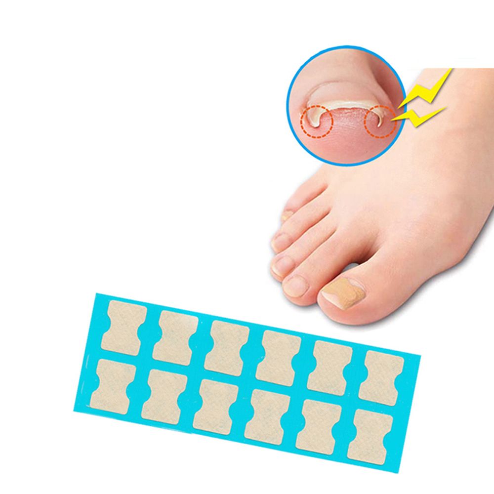 Ingrown Nail Correction Kit Ingrown Toenail Stickers Toe