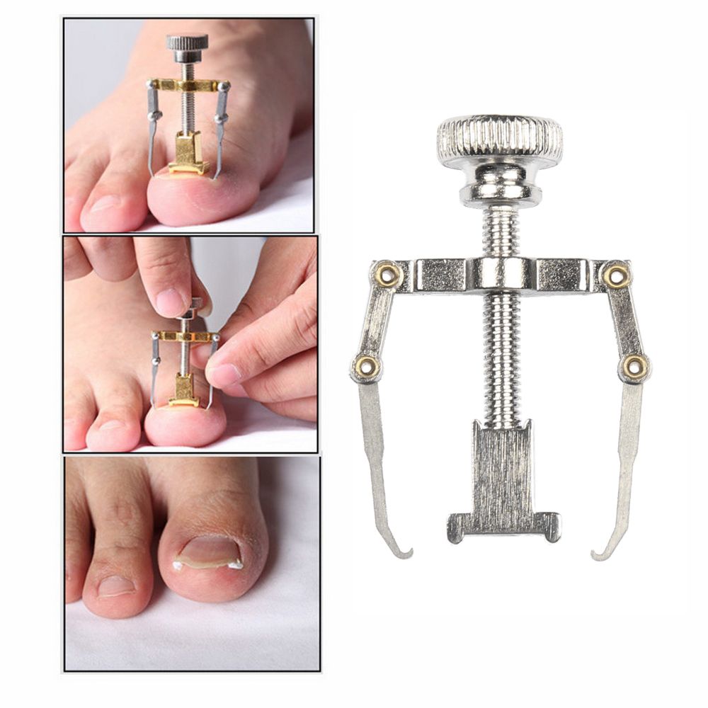 Ingrown Nail Correction Kit Ingrown Toenail Stickers Toe