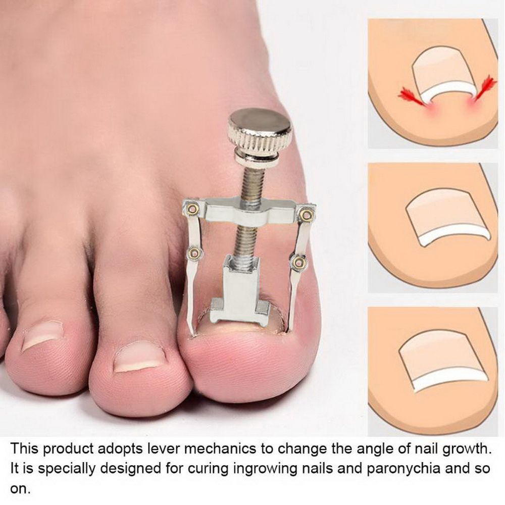 Ingrown Nail Correction Kit Ingrown Toenail Stickers Toe