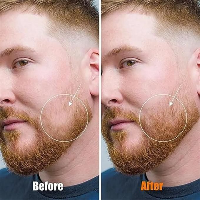 Derma Roller 0.5mm 540 for skin, beard and hair