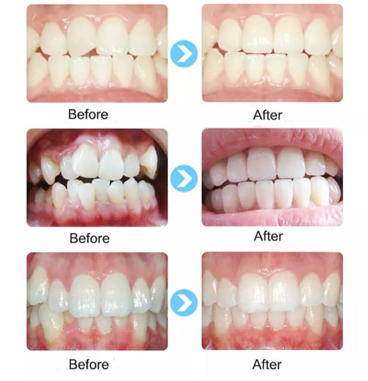 Children Orthodontic Teeth Braces Trainer/retainer-2 Stage