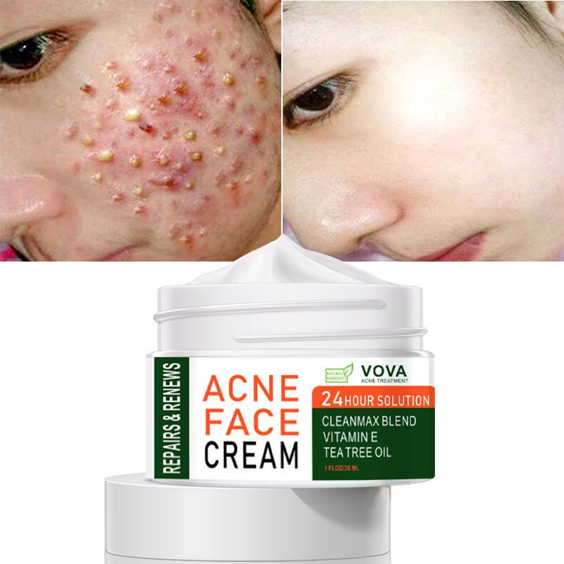 Acne Treatment Face Cream Spots Oil Control