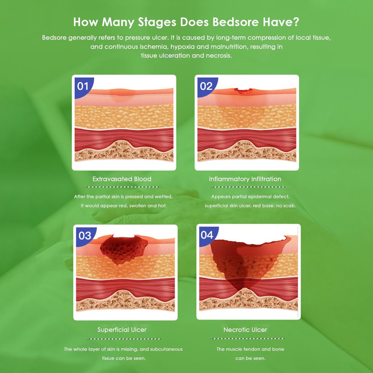 1PC Alginate Wound Dressing High Absorbency Bedsore Patch Pressure Ulcer Treatments Body Surface Application