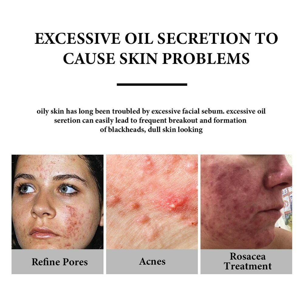 Azelaic Acid 20% Acne & Dark Spots Removal Cream