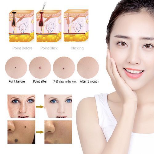 LCD Plasma Laser Indicator Kit For Removing Moles, Blackheads - Gold