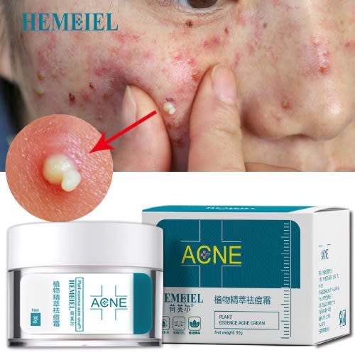 Anti Acne Removal Cream - Pimple Blackhead Moisturizing Cream - 30g