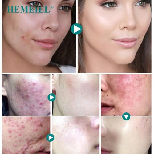 Anti Acne Removal Cream - Pimple Blackhead Moisturizing Cream - 30g