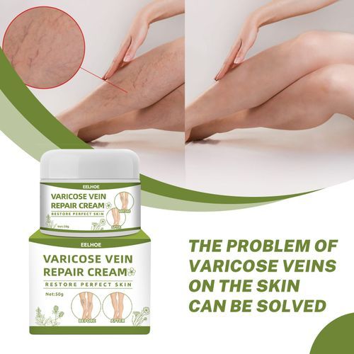 Varicose Veins Cream Removal Treatments