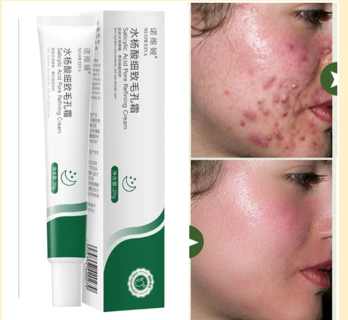 Salicylic Acid Acne,pimple Treatment & Scar Removal Cream