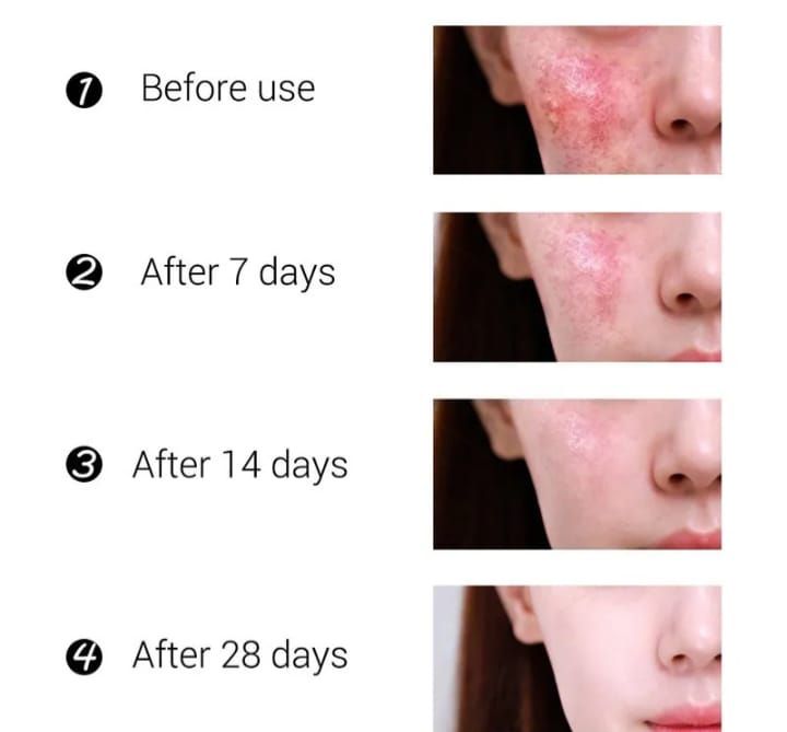 Salicylic Acid Acne,pimple Treatment & Scar Removal Cream