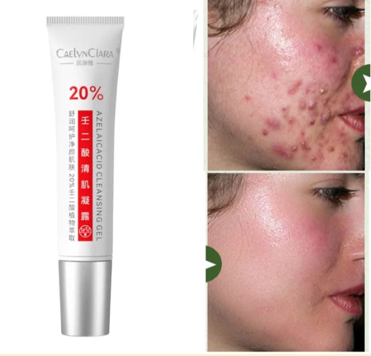 Powerful 2 In 1 Azelaic Acid 20% & Salicylic  Acne Treatment