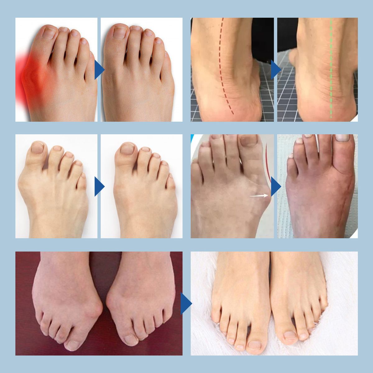 Silicone Bunion Corrector Toe Separator Relieve Swelling