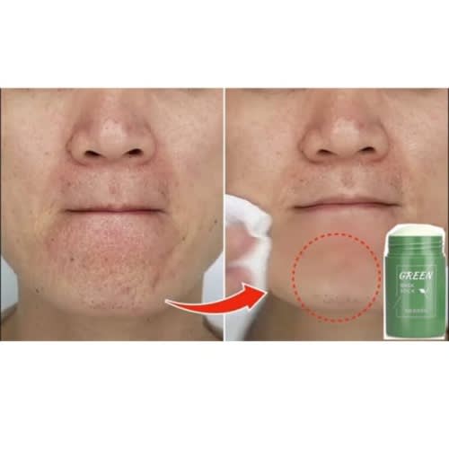 Green Mask Acne - Scar & Blackhead Remover With Facial Oil Control - 40g