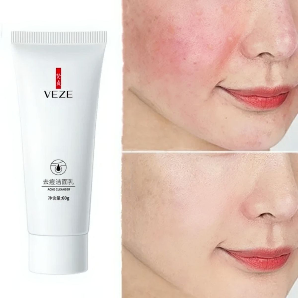 Acne Facial Wash/ Cleanser ( Clear Acne &  Oil Control For Acne Prone Skin).
