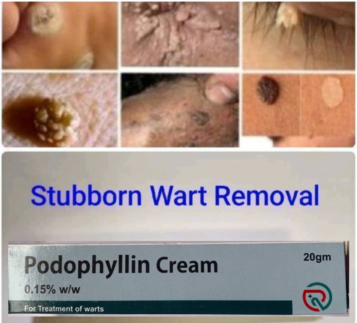 Podophyllin Cream For Stubborn Warts