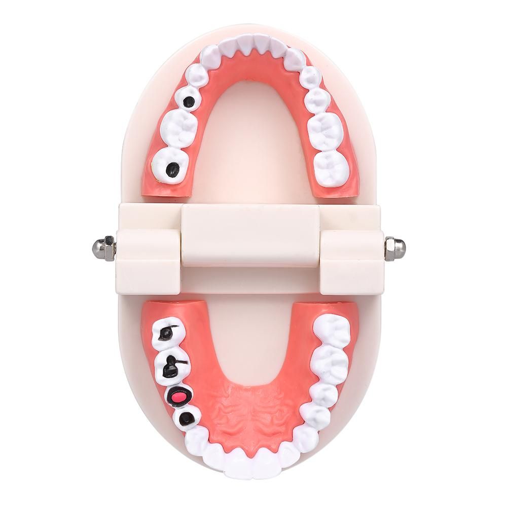 Standard Tooth Teaching Giant Dental Dentist Teeth Model Child Kidtraining Model Disease Teeth Medical Educational Model