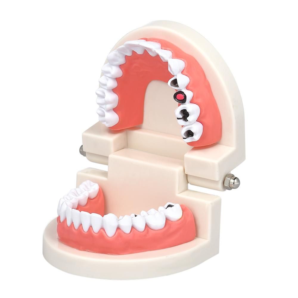 Standard Tooth Teaching Giant Dental Dentist Teeth Model Child Kidtraining Model Disease Teeth Medical Educational Model