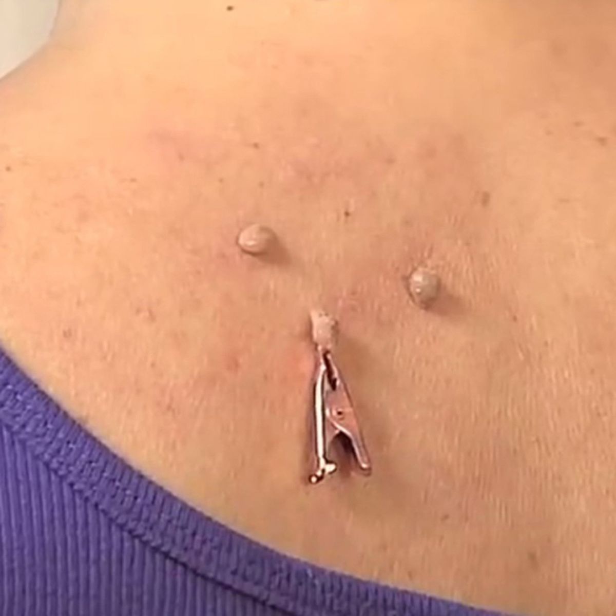 12 Pieces Skin Tag Removal Clips Small Clip For Getting Skin