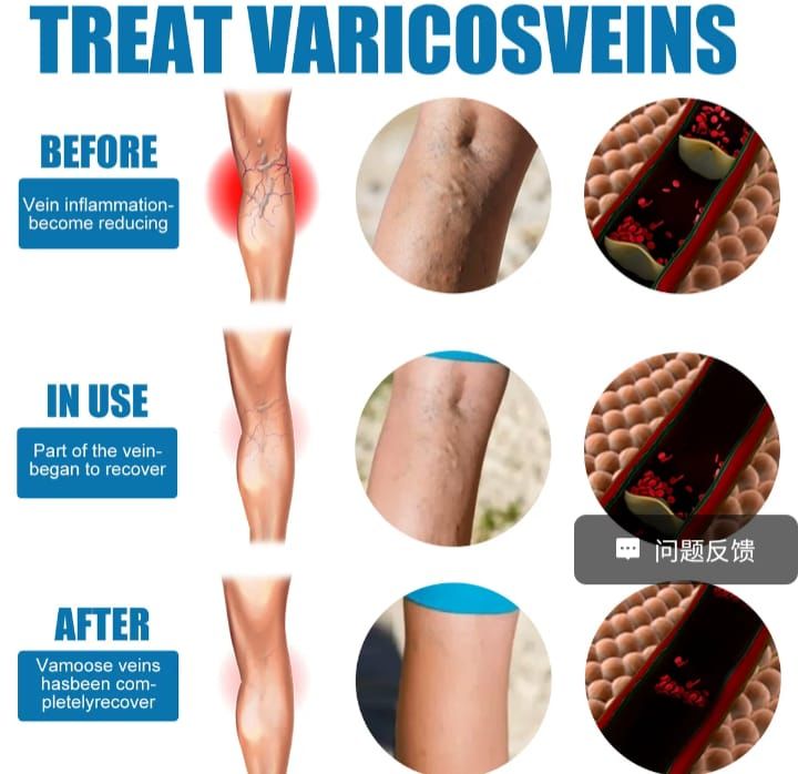 Premium Varicose Vein Removal Cream