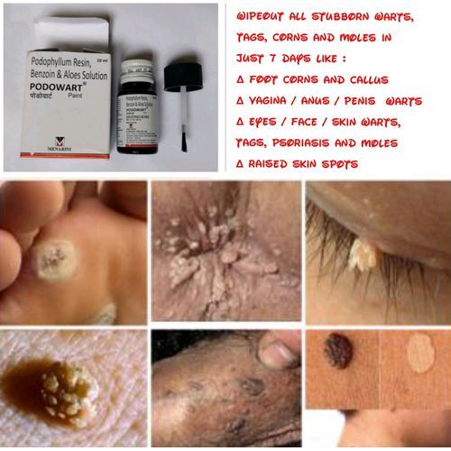 Podophyllum Resin Benzoin & Aloes Solution