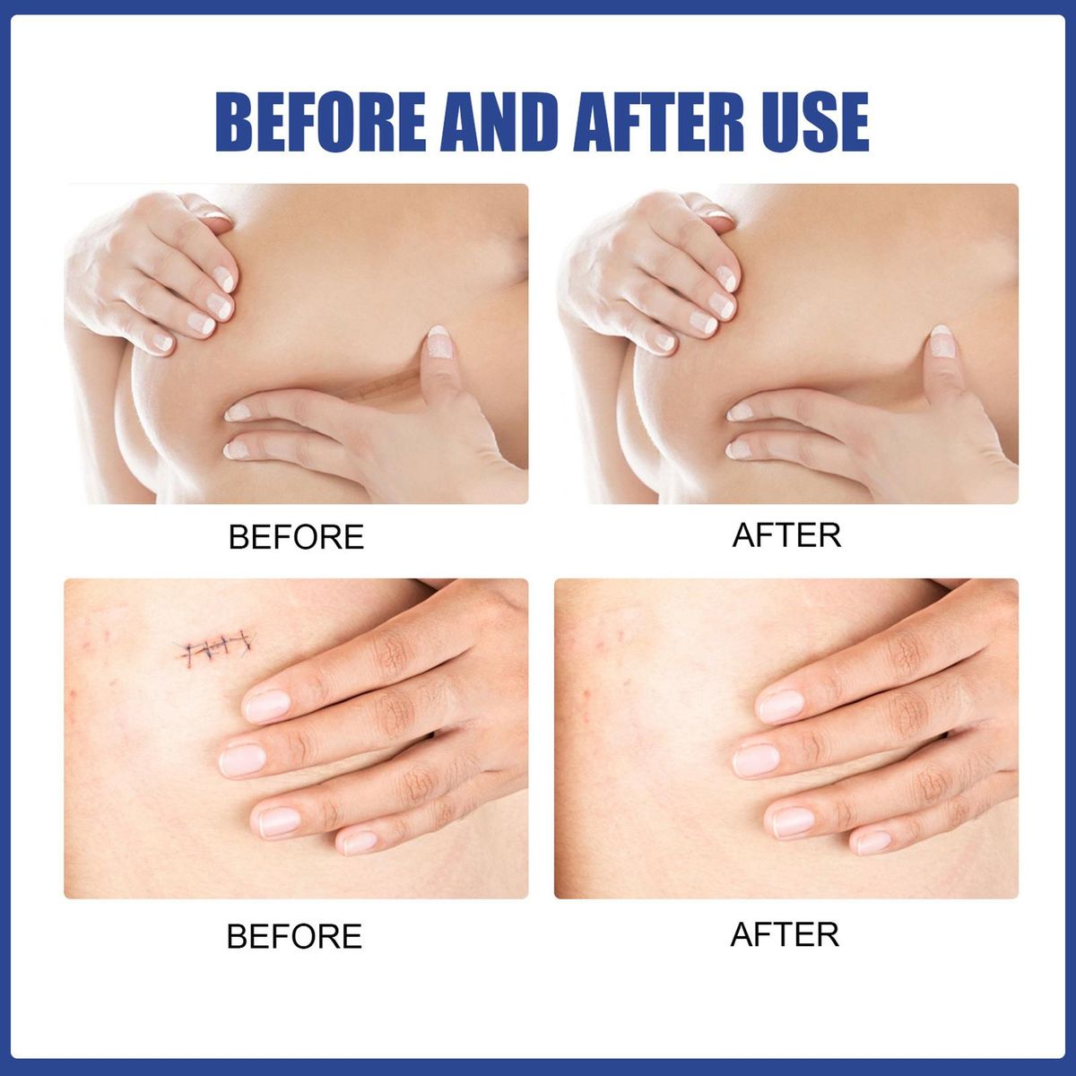 EELHOE 4 Pairs Breast Silicone Scar Sheets Safety Mild Reduce Flatten Dilute Soften Scars Hypoallergenic Waterproof Washable