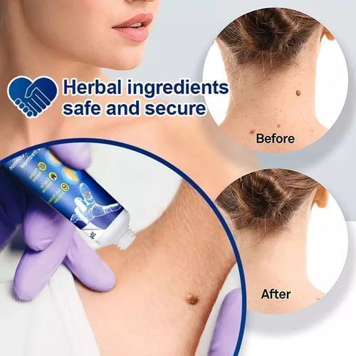Wart Removal Herbal Ointment  Cream