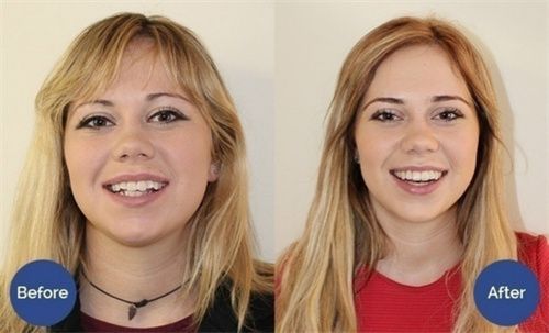 3 Stages Teeth Corrector Bend Brace Aligner
