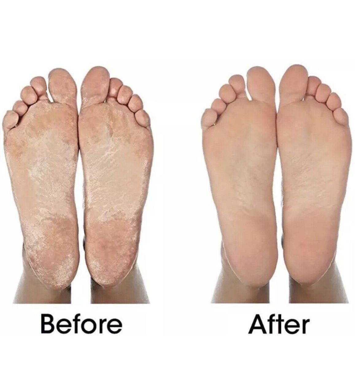 Pedi Foot Pedicure Roller Feet Dead Skin Remover (WASHABLE)